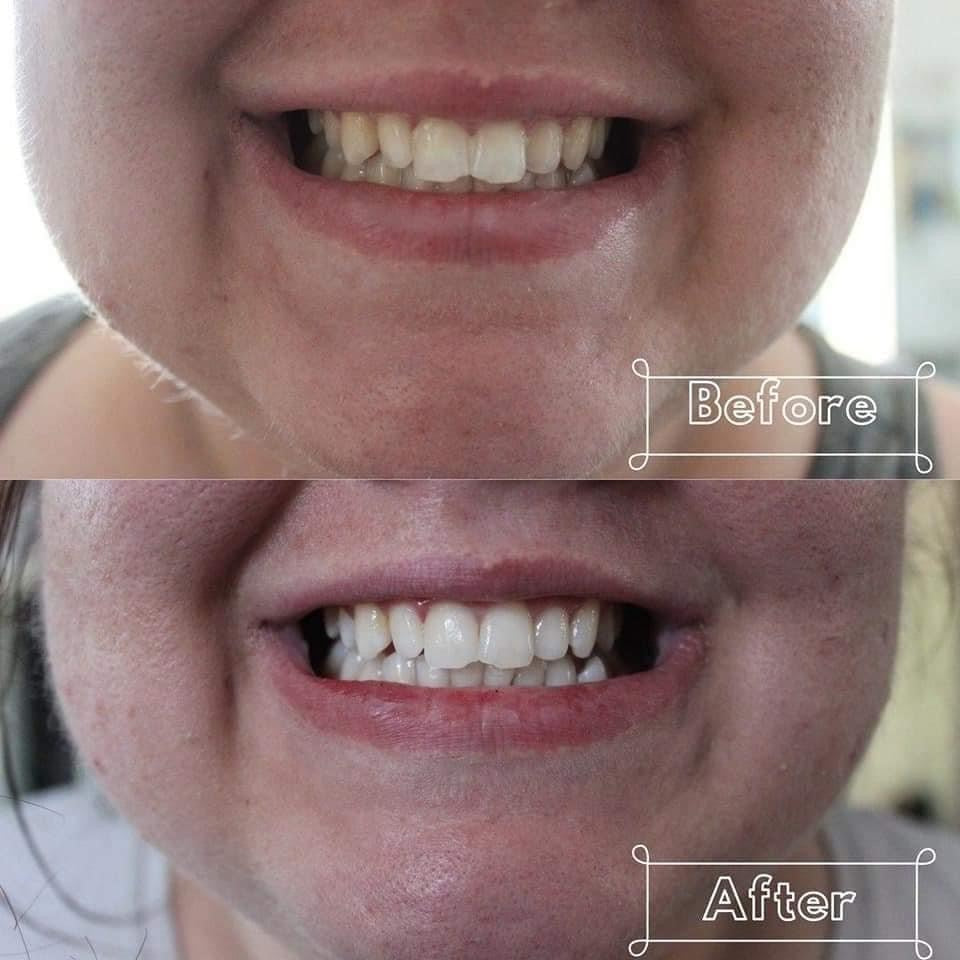 L.E.D Teeth Whitening Service - The Bee Boutiques